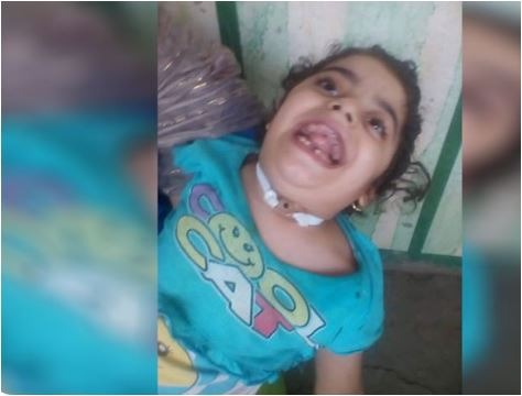  الإهمال الطبي يتسبب في إصابة طفلة من أولاد صقر بـ”شلل رباعي”